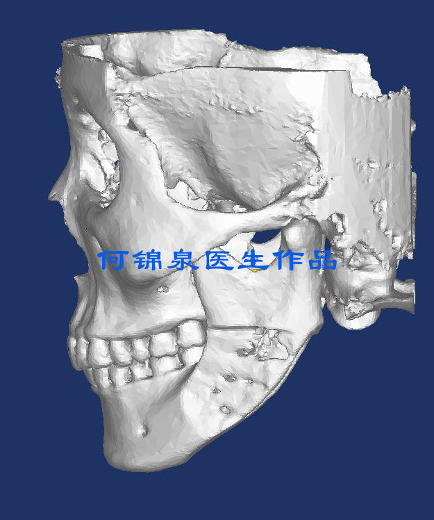 上星期做的下颌角3维ct显示截骨线很平整手术很成功