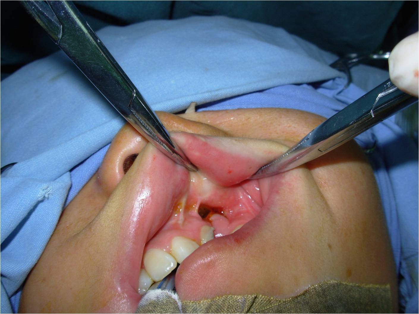 唇裂鼻畸形整复前要通过牙槽嵴裂植骨抬高塌陷鼻翼基底
