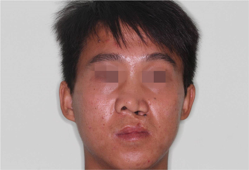 唇裂鼻术前术后效果对比图