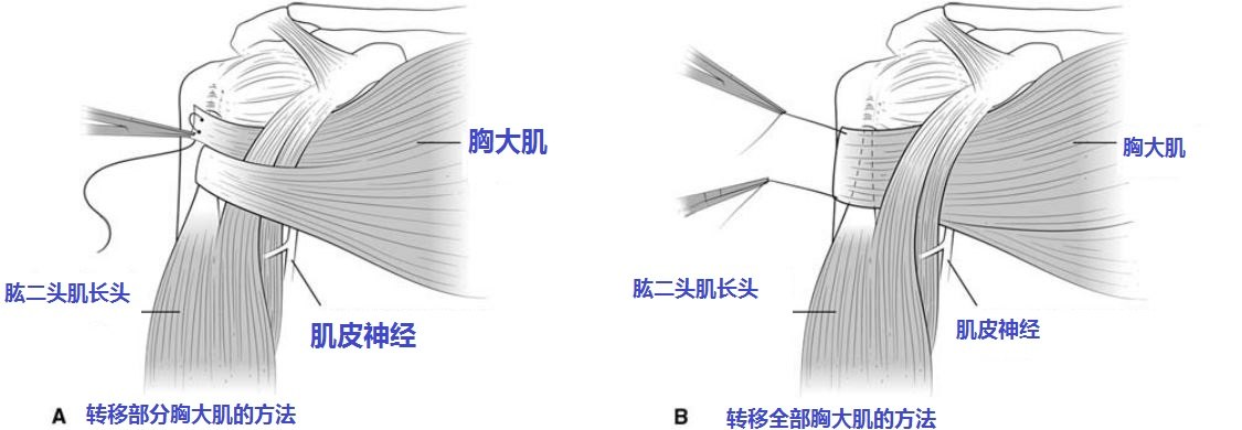 我的肩关节损伤前上方肩袖撕裂能做胸大肌肌腱转位手术么?
