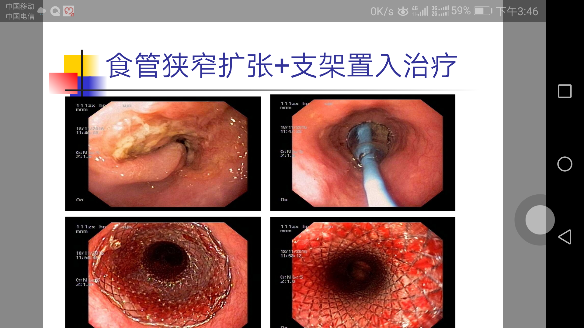 关注胃肠健康,重视胃肠镜检查,合理抗胃幽门螺杆菌治疗