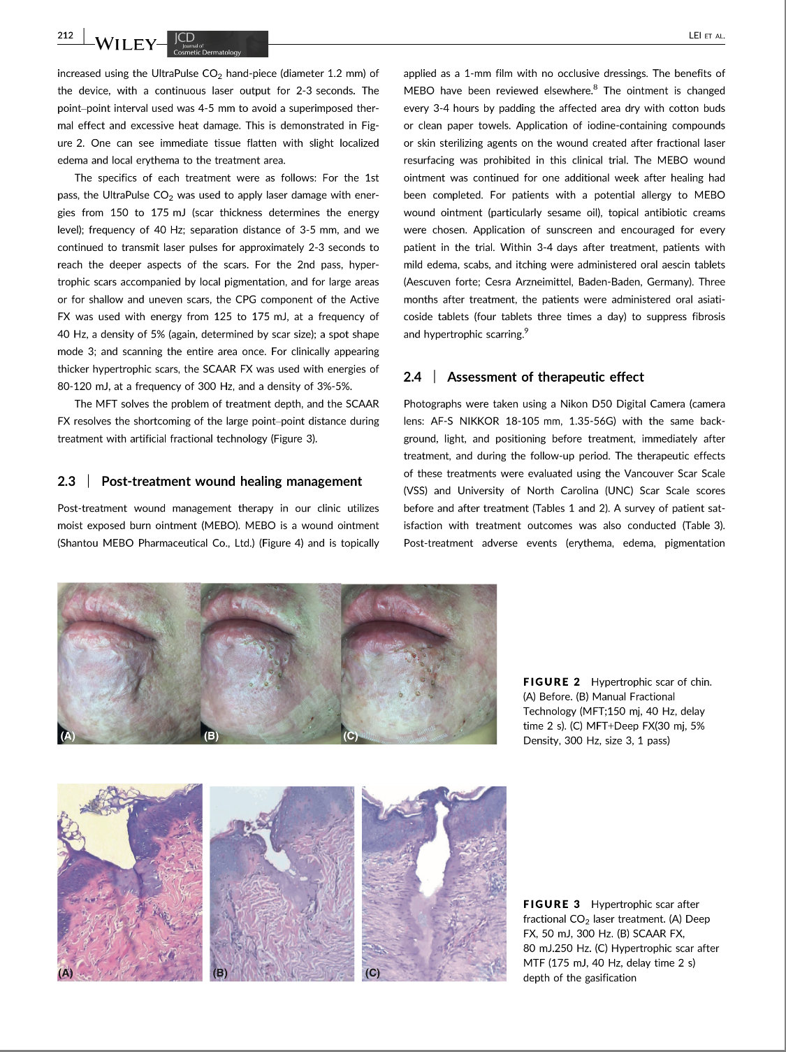 超脉冲CO2点阵激光治疗增生性疤痕(美国美容
