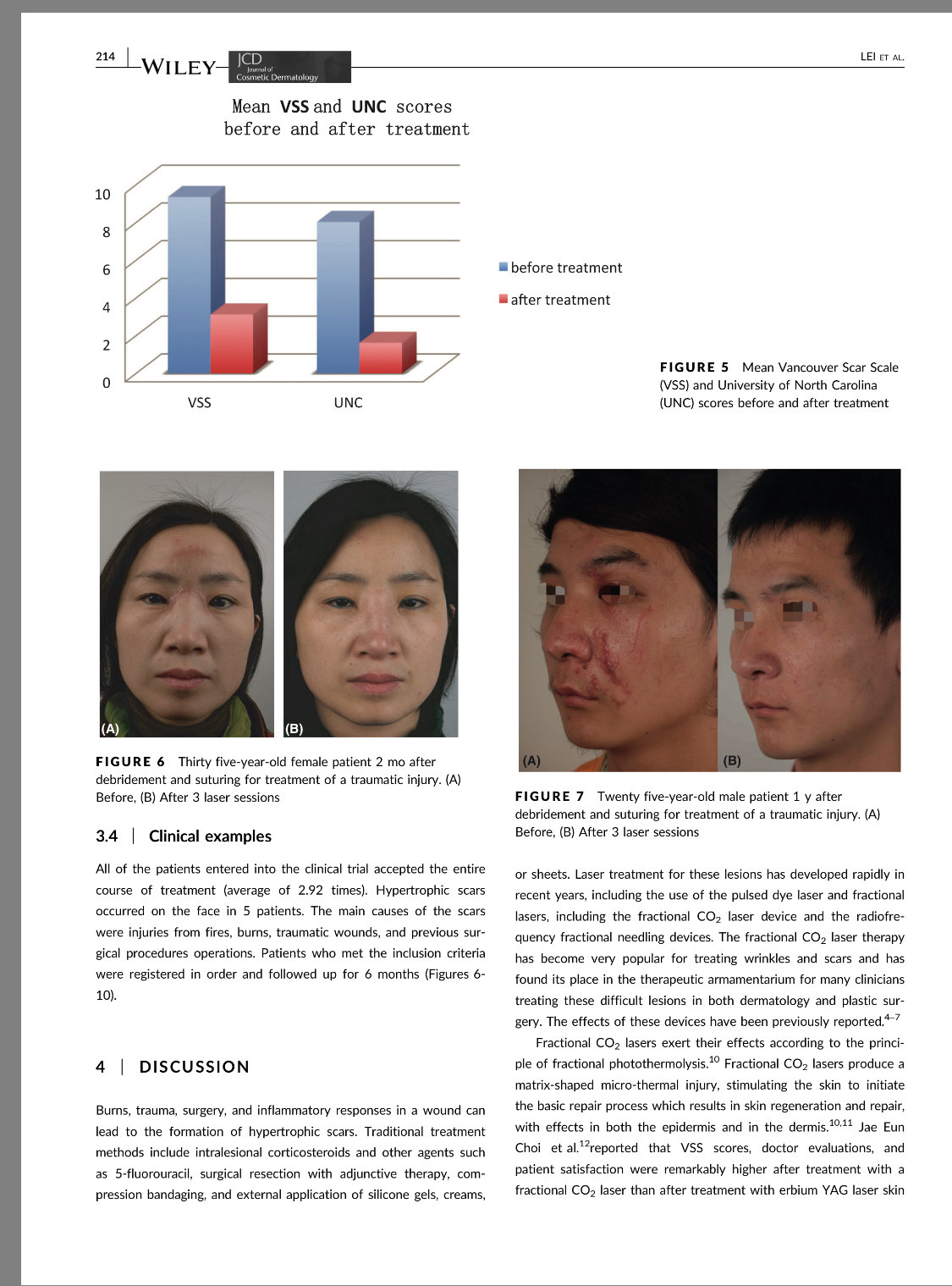 超脉冲CO2点阵激光治疗增生性疤痕(美国美容