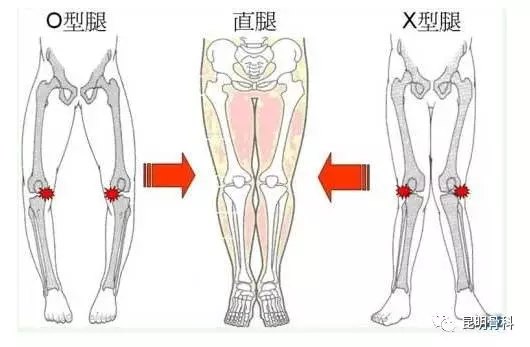 幼儿的o型腿及x型腿