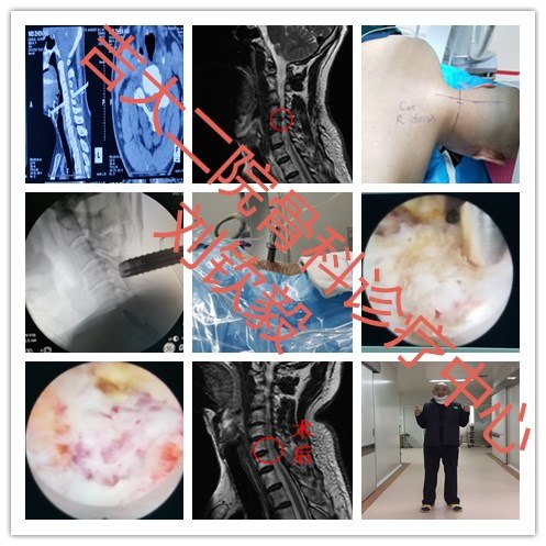 吉林大学第二医院 刘钦毅 颈椎病孔镜微创手术,止痛立竿见影!