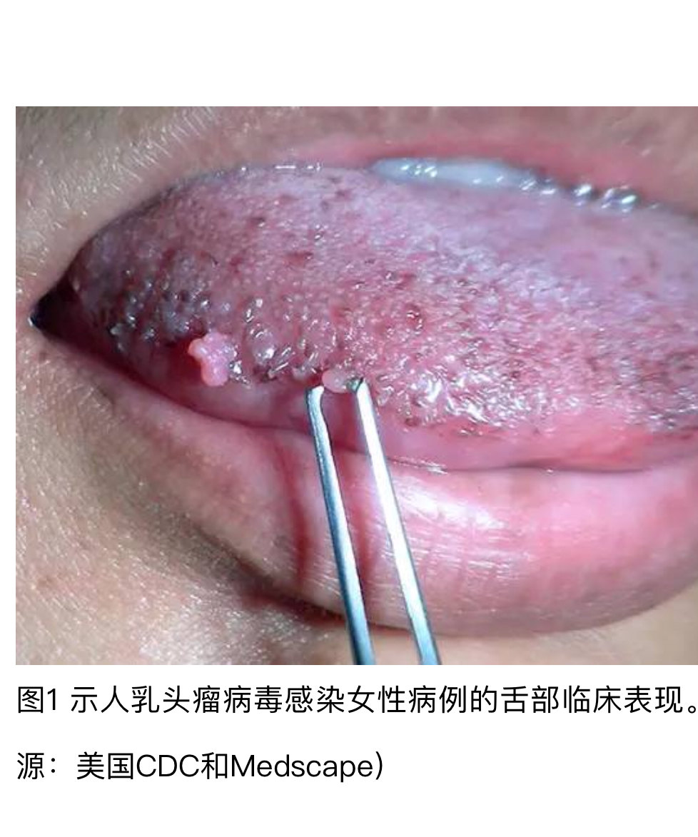 口腔典型尖锐湿疣图片