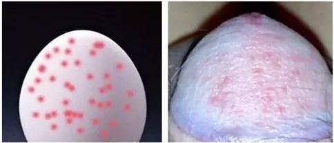 包皮龟头炎反复发作,可能是糖尿病惹的祸!