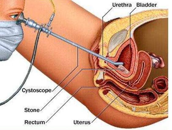 1497517131956666.jpg 膀胱镜检查图.jpg