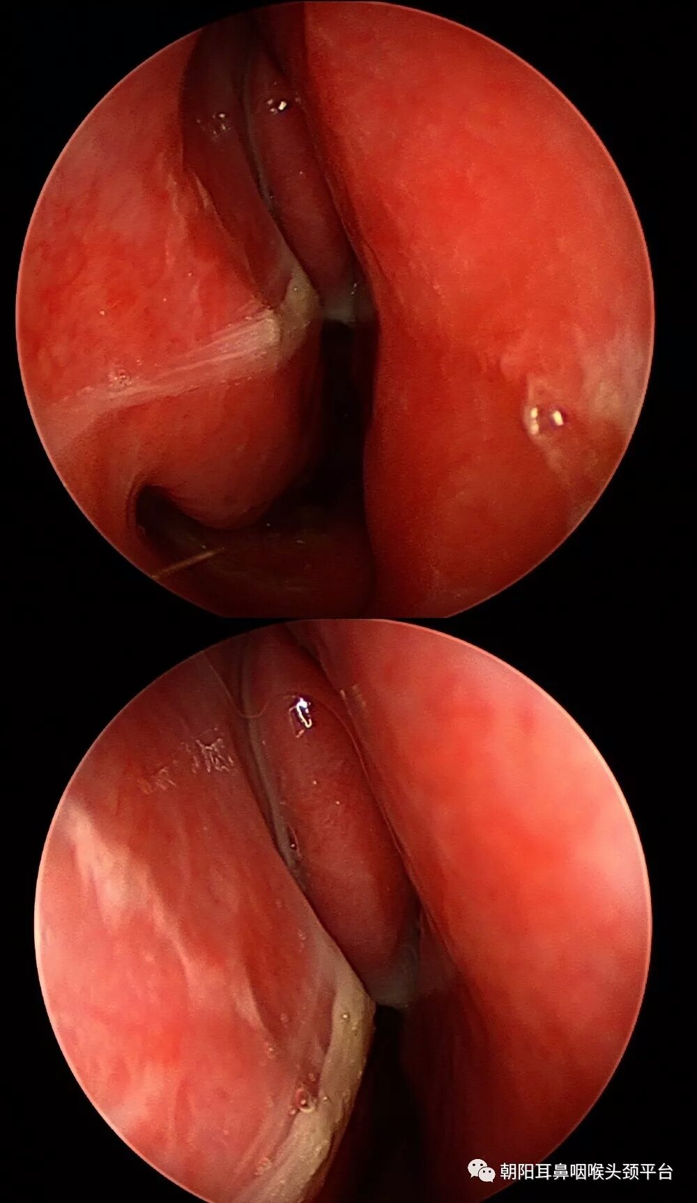 感冒了头疼,什么原因?