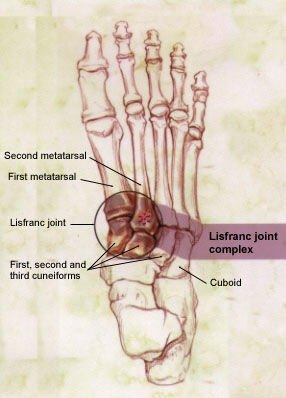 足部严重损伤 骨折 关节脱位 Lisfranc损伤 - 好大