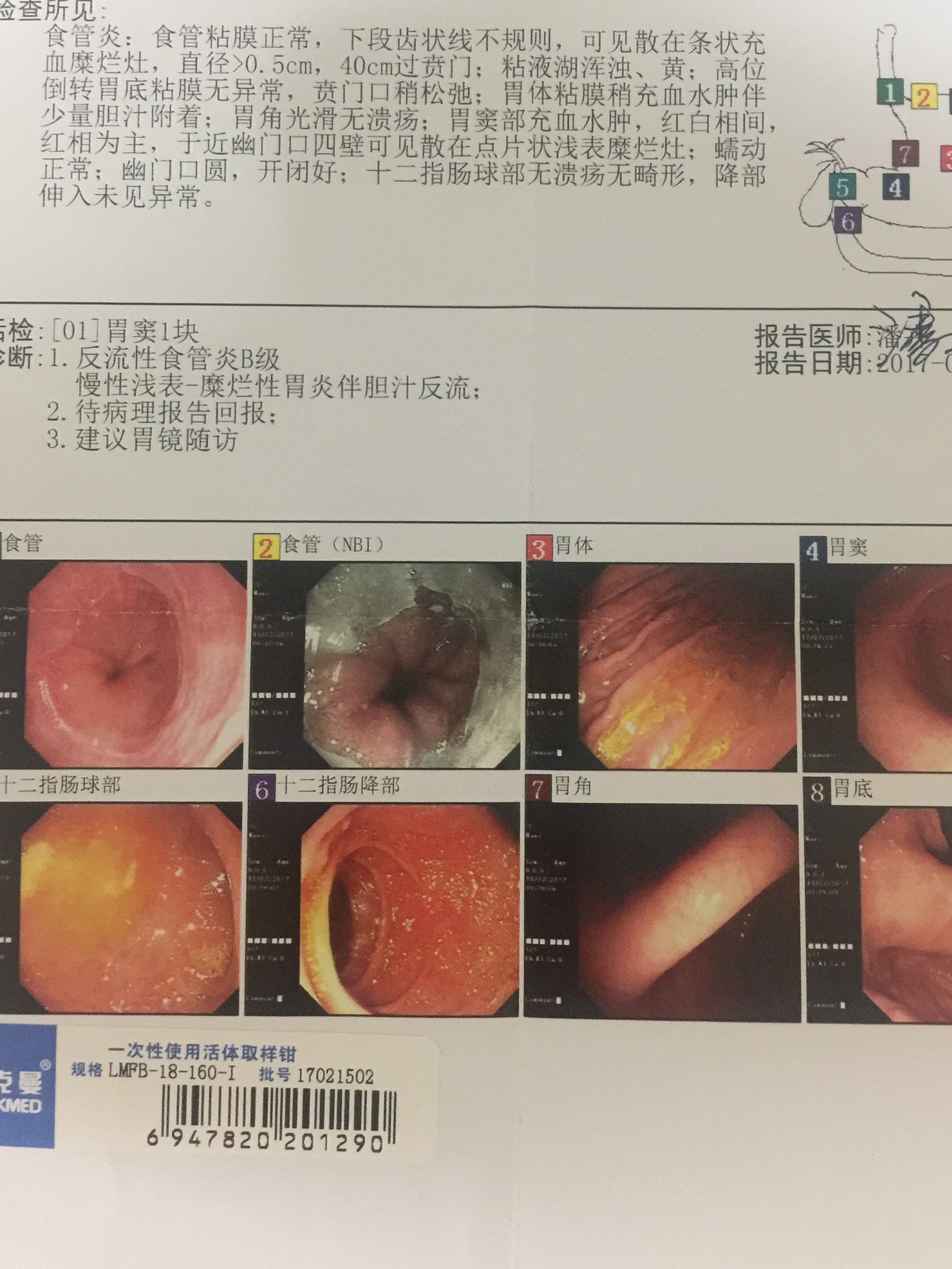 胃镜提示反流性食管炎b级.