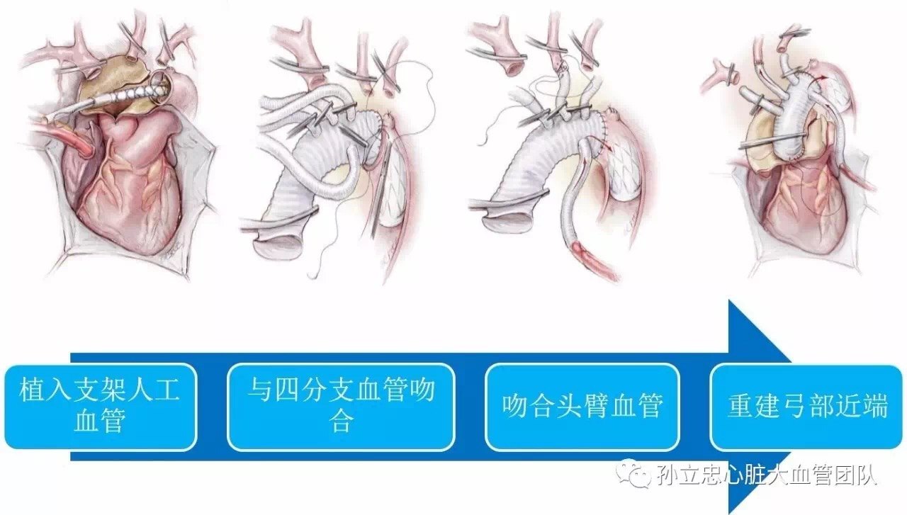 安贞医院孙立忠团队:孙氏手术可改善Stanford