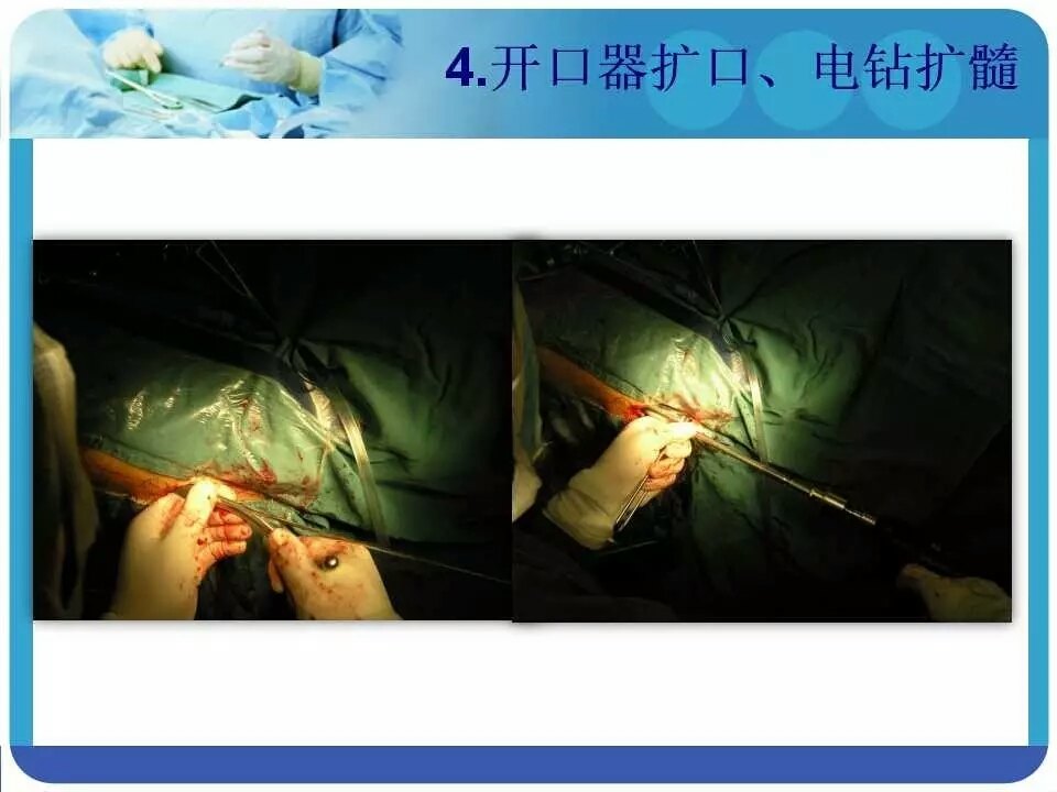 pfna治疗股骨粗隆间骨折,让你看明白