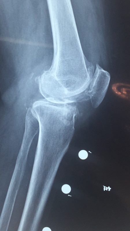 术前x线显示严重髌股关节炎,骨质增生
