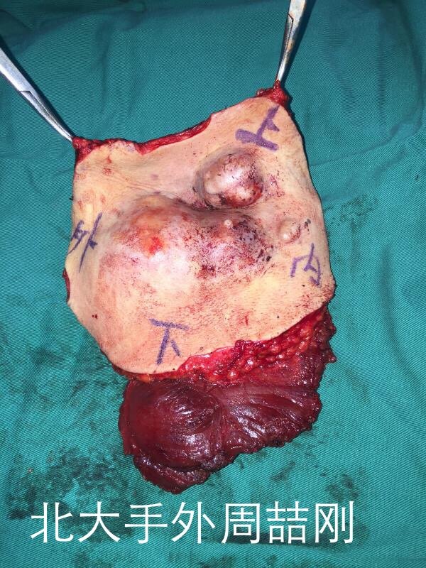 胸壁巨大隆突性皮肤纤维肉瘤的根治性切除