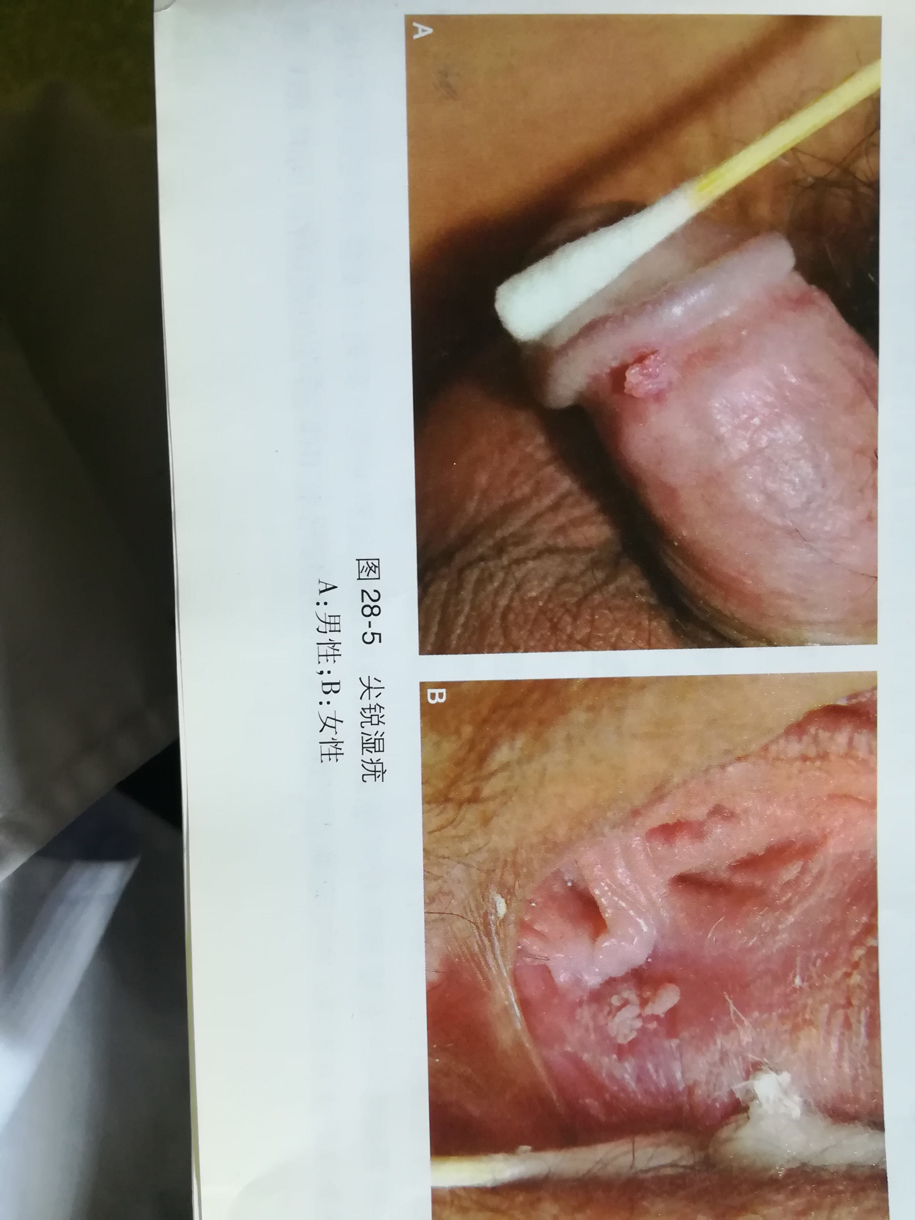 王伟 文章列表  尖锐湿疣:是由人乳头瘤病毒所致,常发生在肛门及外
