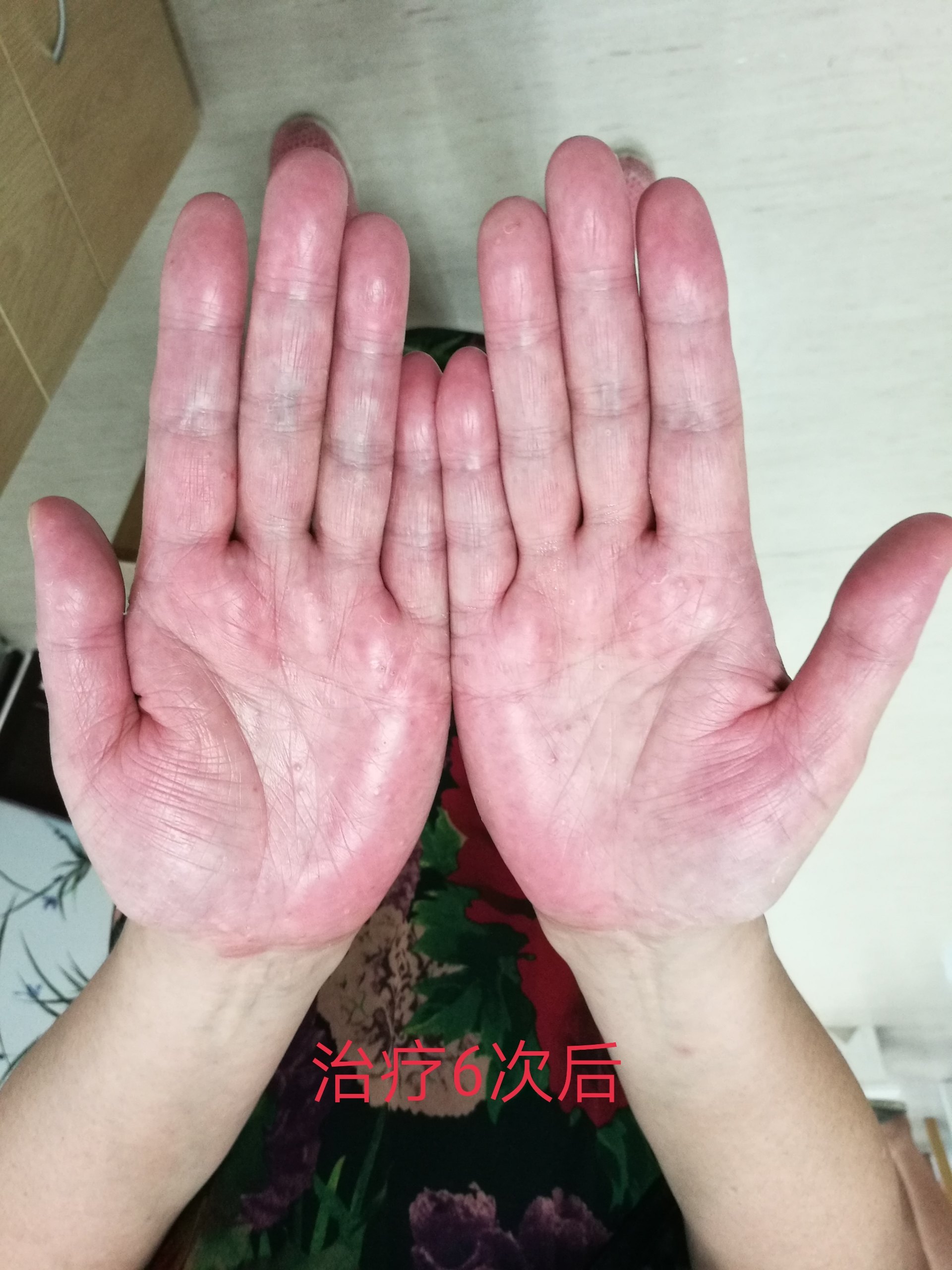掌跖脓疱病,基本上每日1次治疗,6次治疗后的变化.