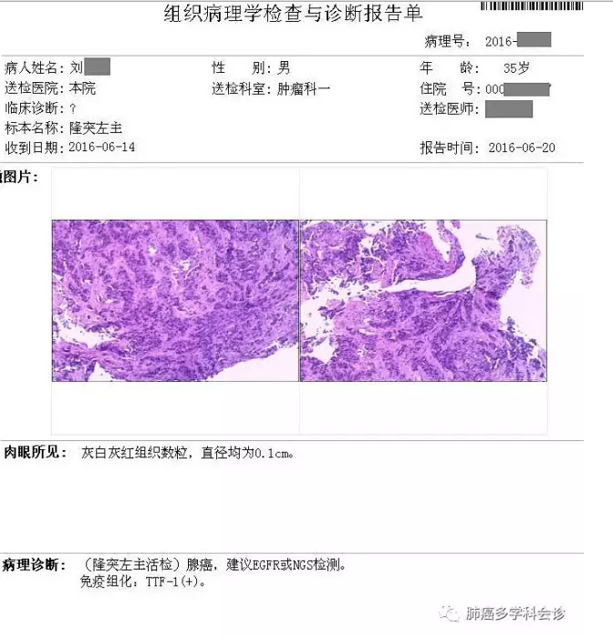 肺癌食管转移?食管癌与肺癌并存?