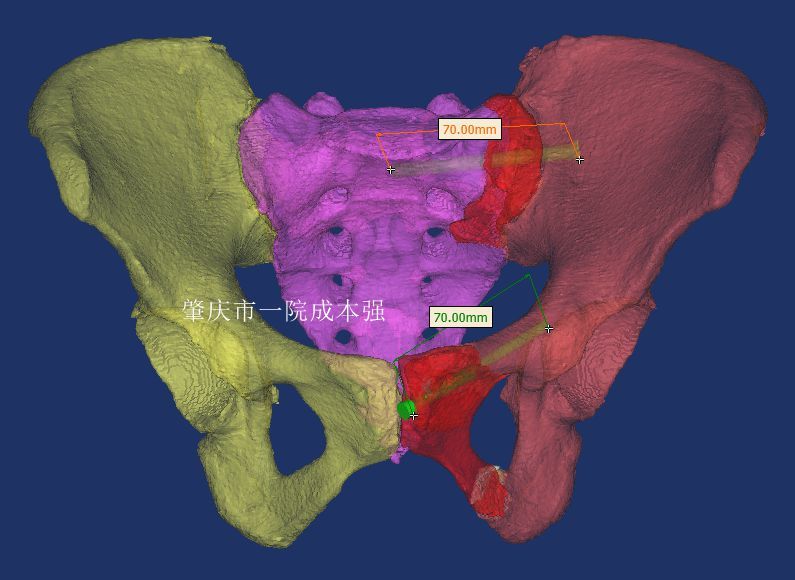 多发伤并骨盆环不稳定骨折的局麻微创固定骶骨