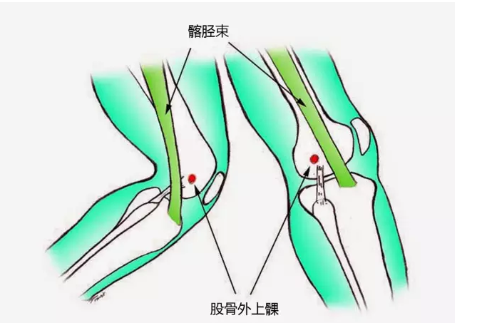 髂胫束是阔筋膜张肌和臀大肌共同沿大腿向下形成的肌腱结构,也是连接