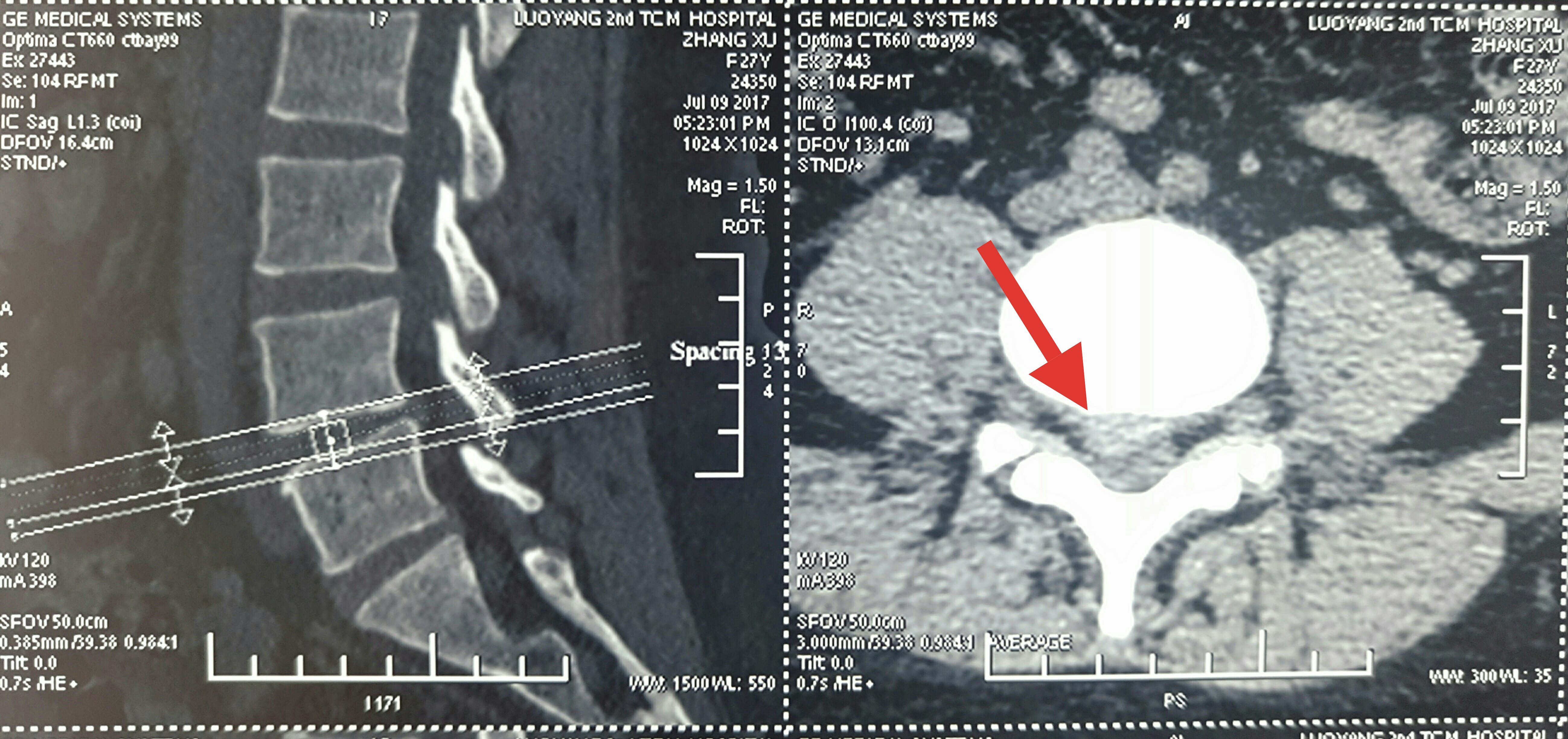 脊柱内镜翻修腰椎间盘突出症胶原酶溶核术后复