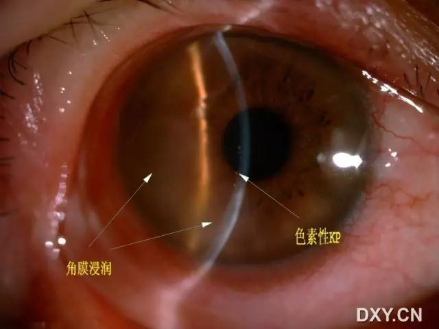 眼科医生多年总结:眼前节病例照片