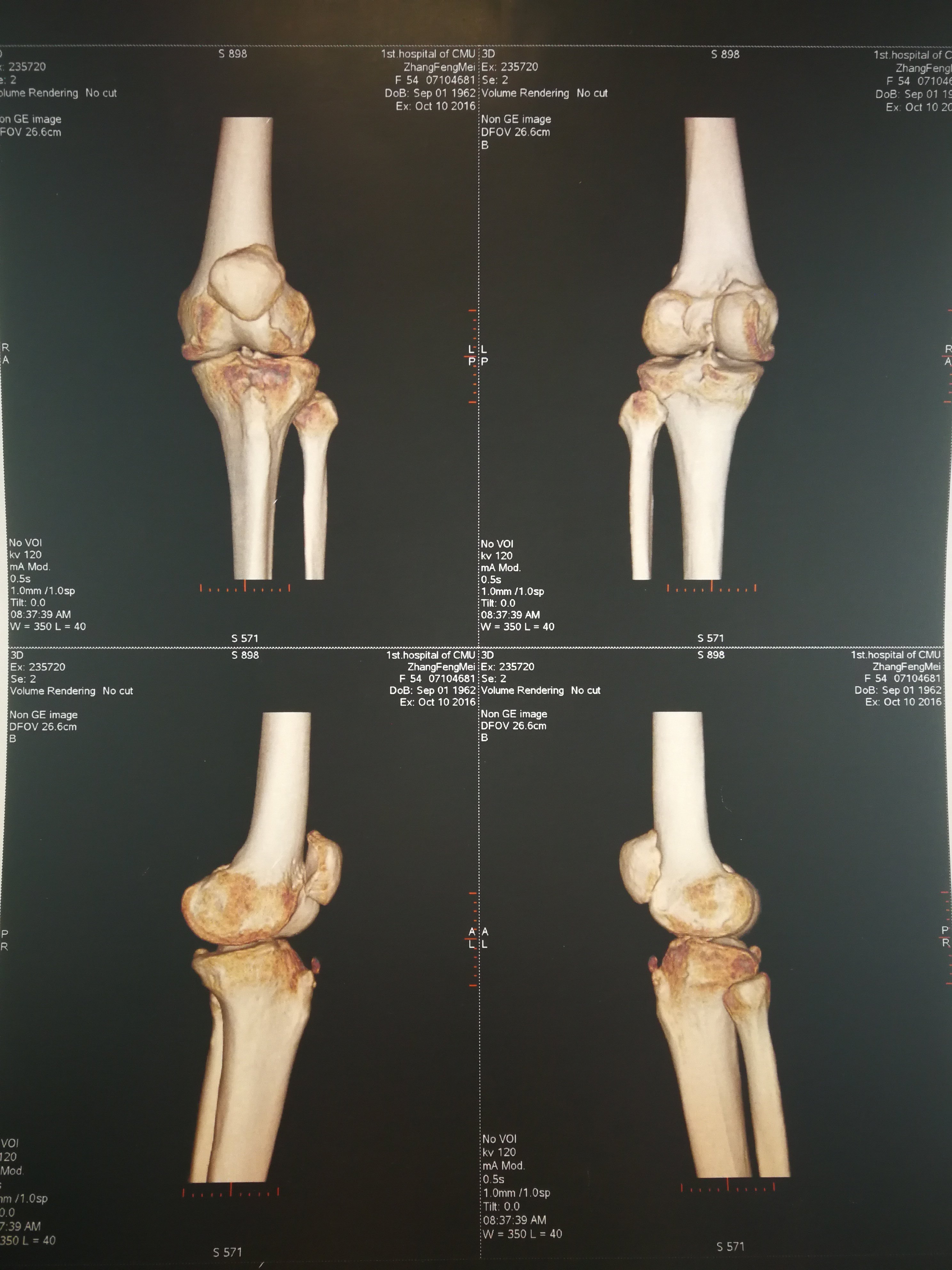 高位髌骨髌股关节炎胫骨结节移位术