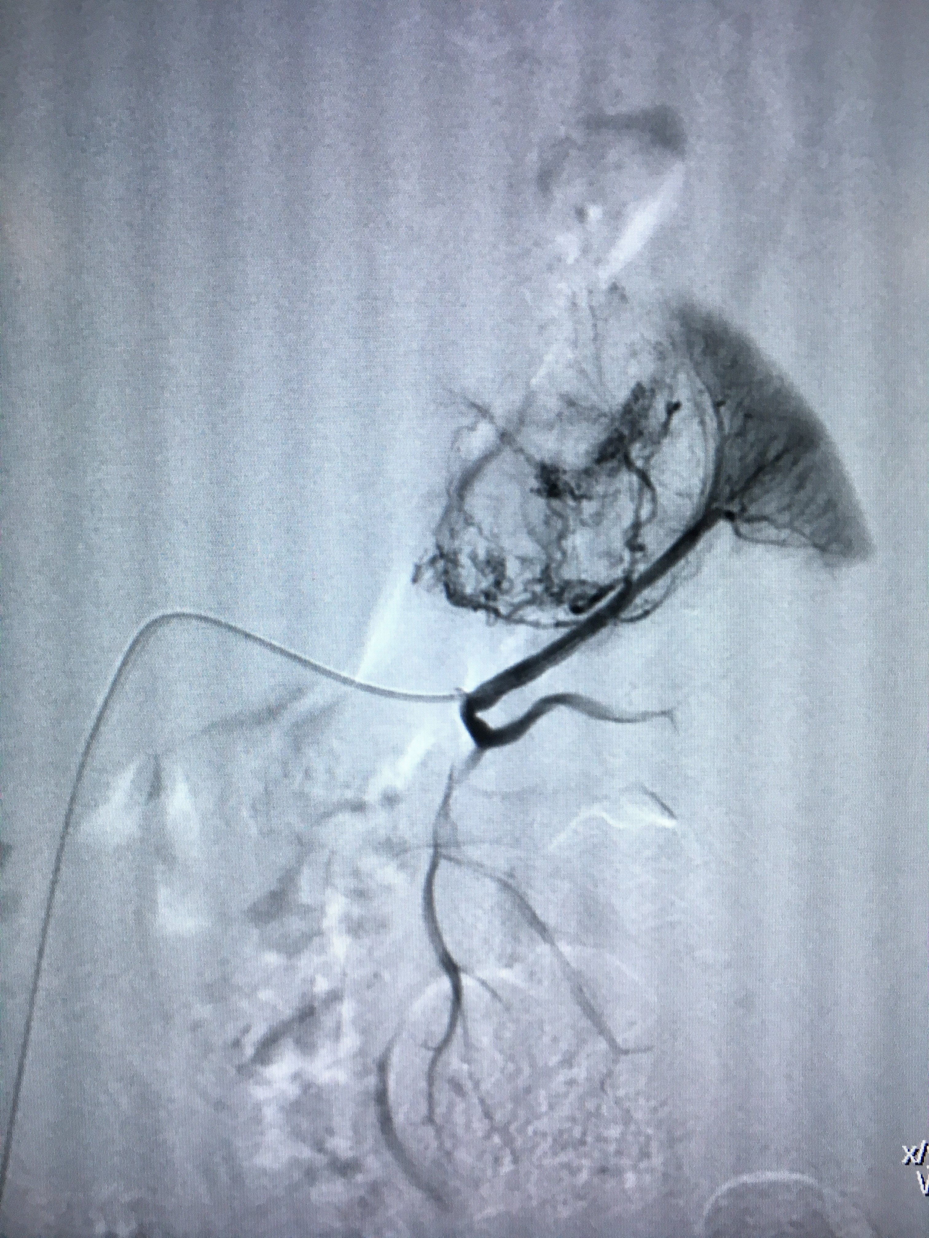 肾错构瘤介入治疗