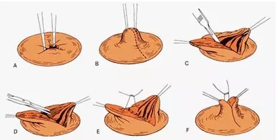 乳头内陷矫正