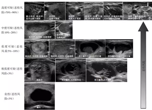 在甲状腺结节的诊断程序中,us是目前敏感性最高的检查方法,可测量