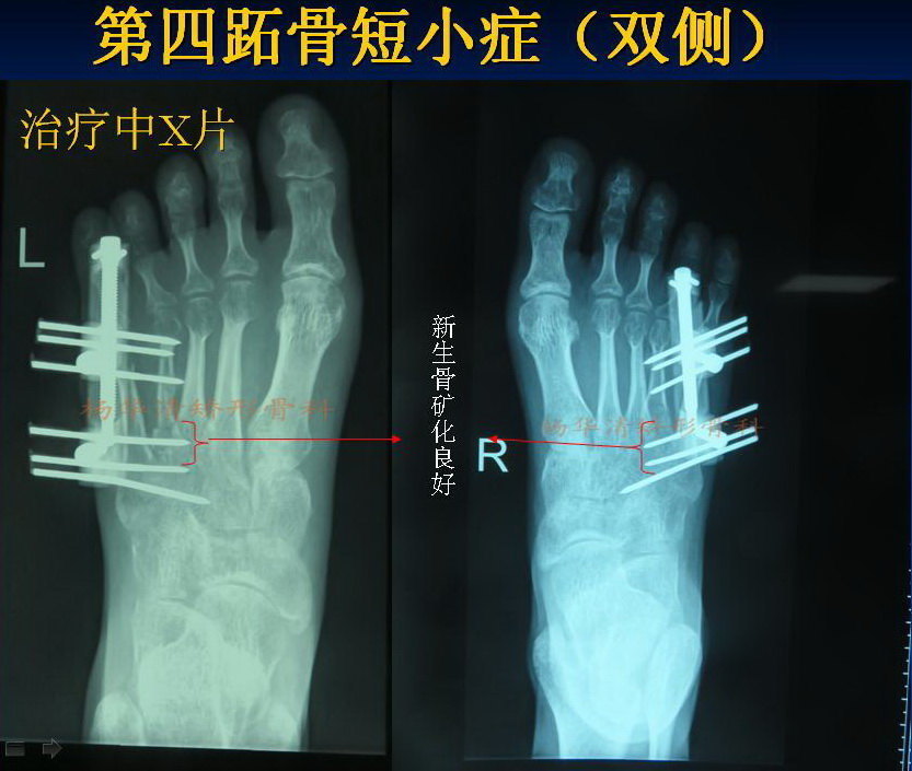 双足第四跖骨短小(典型病例)