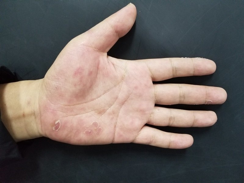 容易误诊的病例之一:梅毒的手部表现