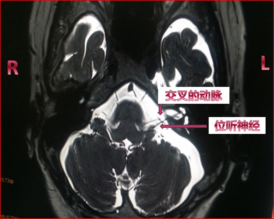 1513512916414349.jpg 前庭阵发症图片.JPG