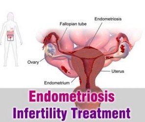 endometriosis-infertility-treatment-300x336.jpg