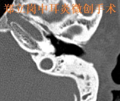 郑立岗中耳乳突炎耳内镜微创+咽鼓管球囊扩张