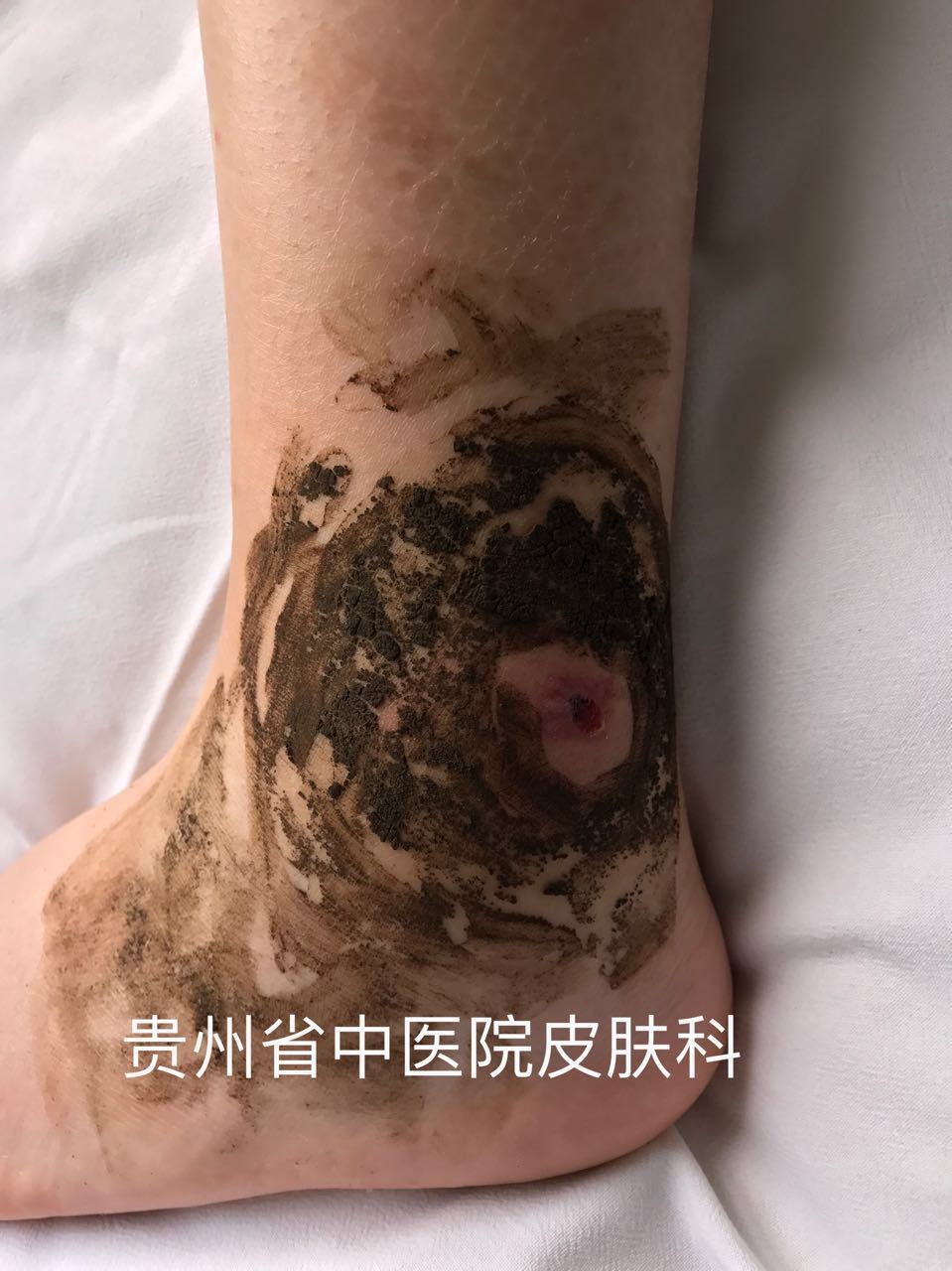 丘疹性荨麻疹…蚊虫叮咬(多图)