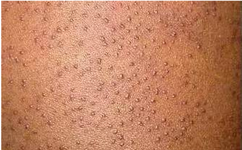 夏季常见皮肤病之三:永不消失的鸡皮疙瘩-毛发苔藓(鸡