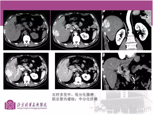 胆管癌的影像学诊断