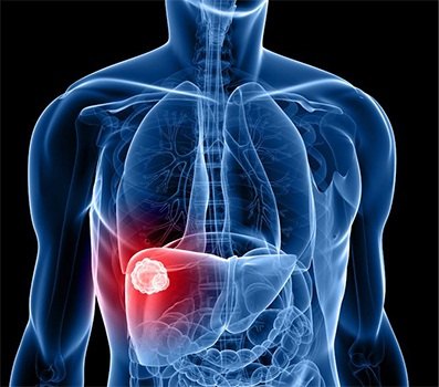 1506267296463023.jpg weight-obesity-liver-cancer-735-350.jpg