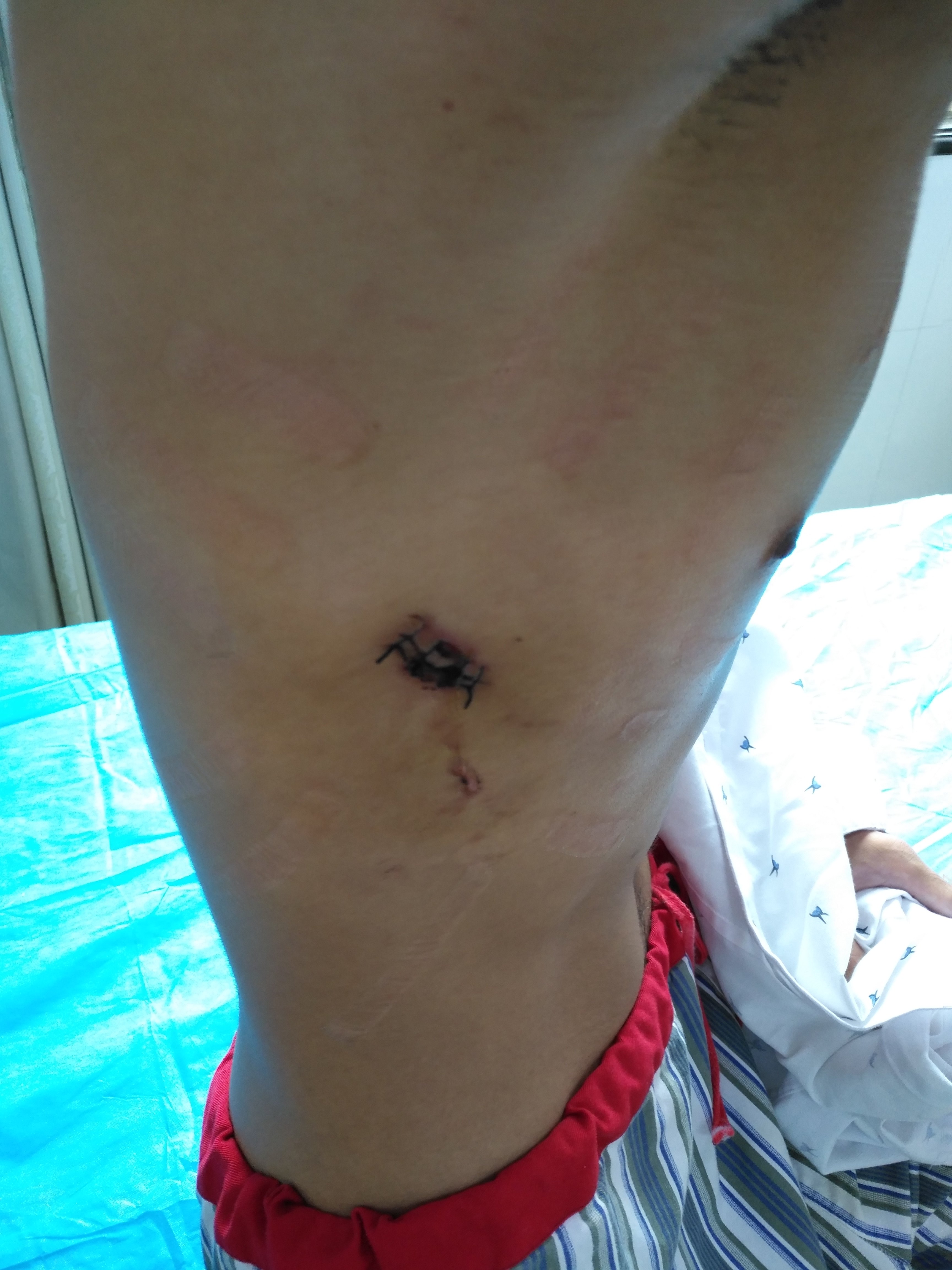 单孔胸腔镜微创手术 治疗肺癌 肺大泡