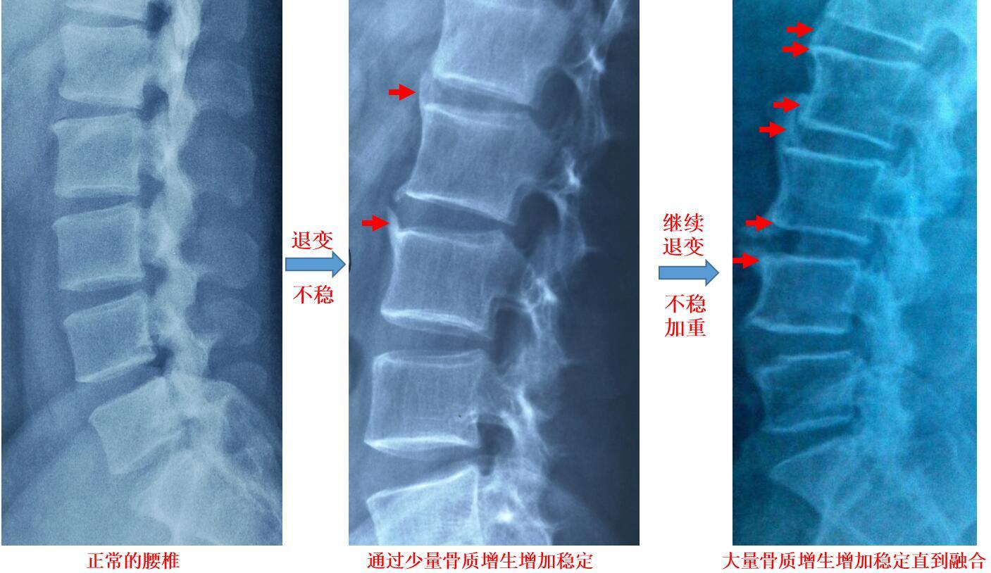 图2 腰椎<!--HAODF:8:guzhizengsheng-->骨质增生<!--HAODF:/8:guzhizengsheng-->演变过程.jpg