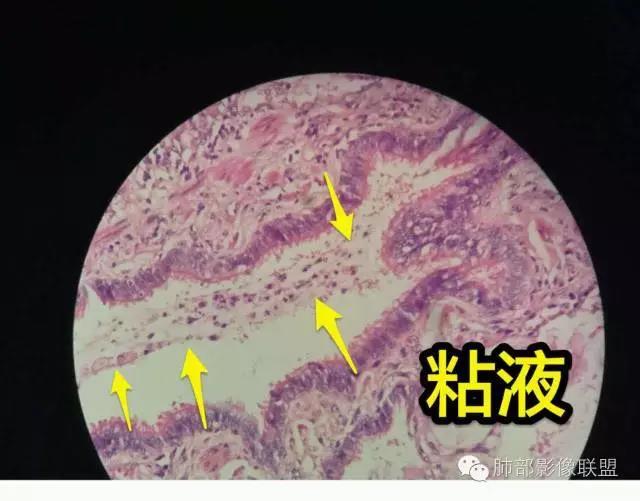 病理影像综合分析粘液性腺癌的枯枝征