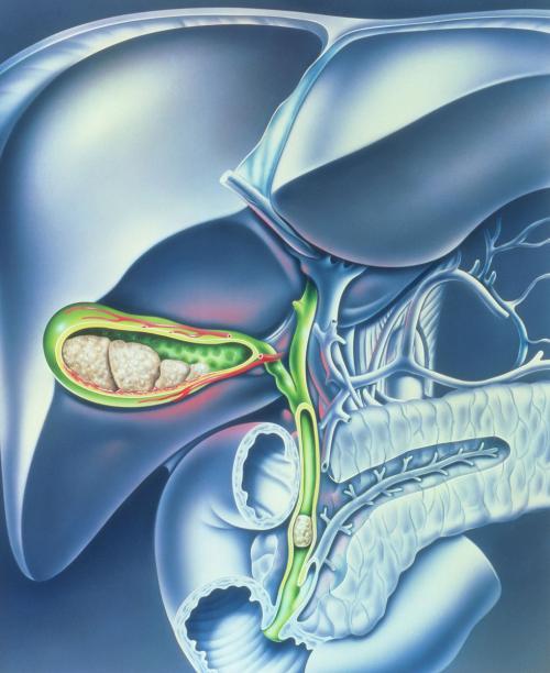 胆总管结石的详细图文治疗