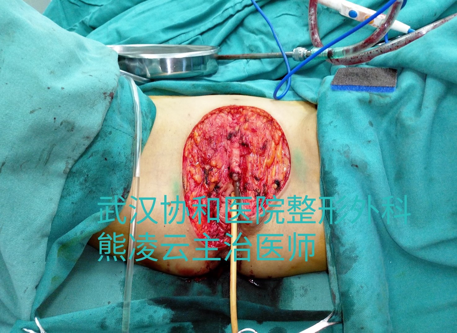 女性外阴肿瘤扩大切除与外阴重建