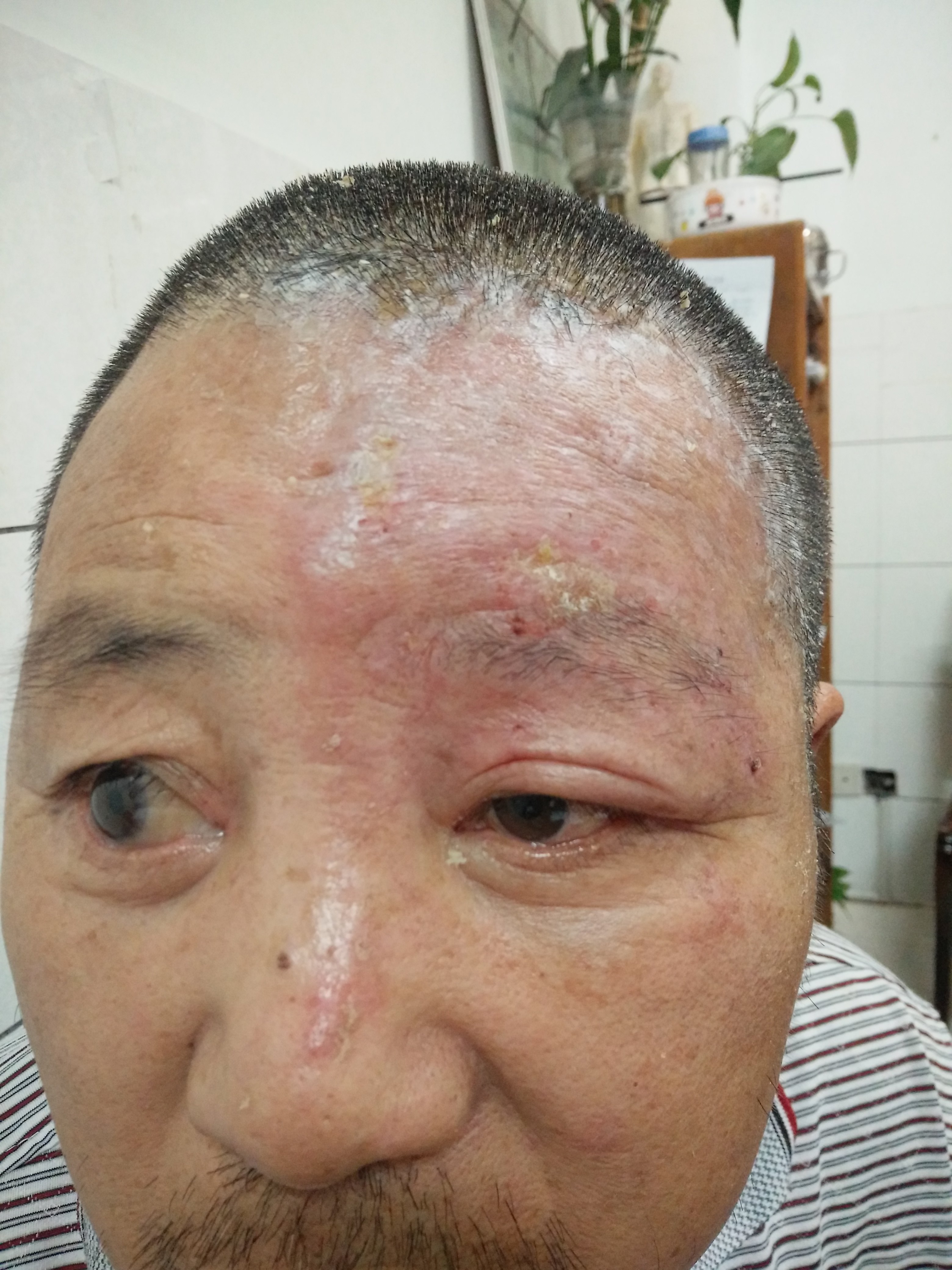 眼睑带状疱疹及引起的病毒性角膜炎的经验治疗.