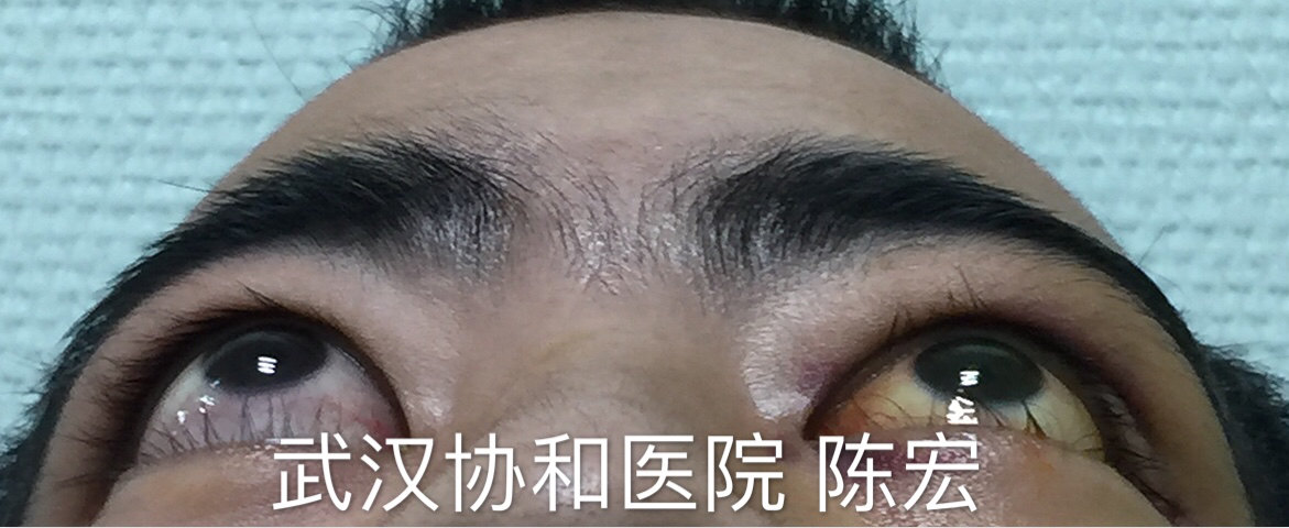 甲状腺相关眼病突眼手术治疗病例