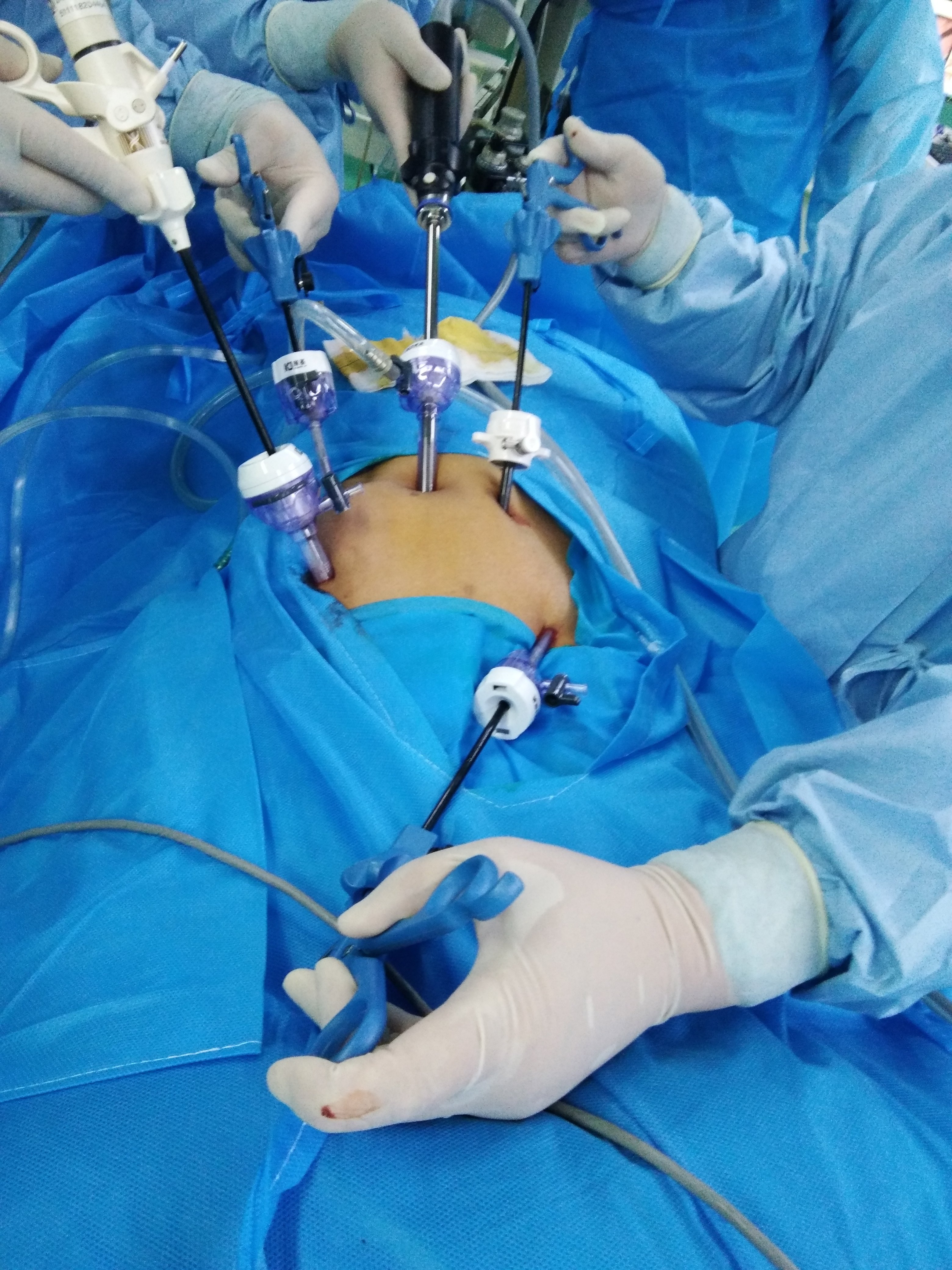 严格培训能大大缩短腹腔镜直肠癌手术学习曲线