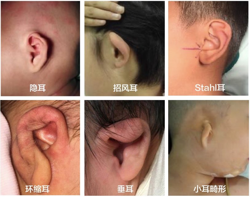 1498755949734935.jpg 耳廓畸形.jpg