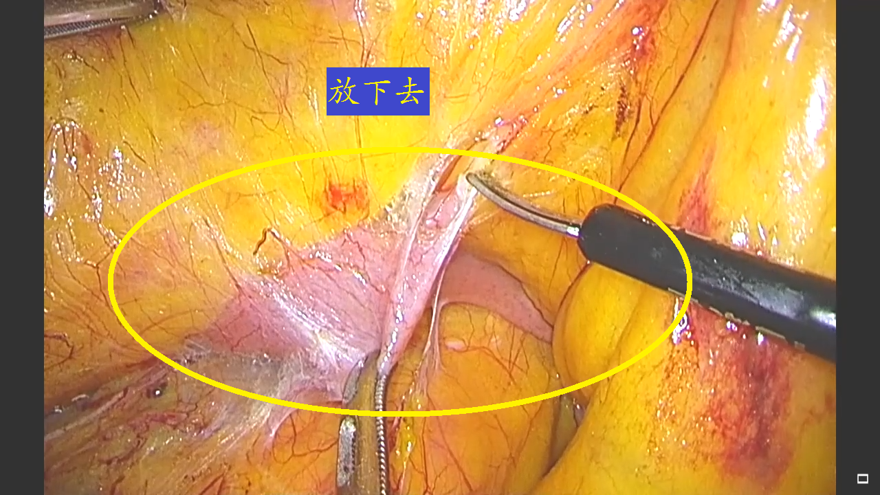 2017.7.7北京 <!--HAODF:8:fuqiangjingshoushu-->腹腔镜<!--HAODF:/8:fuqiangjingshoushu-->辅[00_02_00][20170717-085546-1].PNG