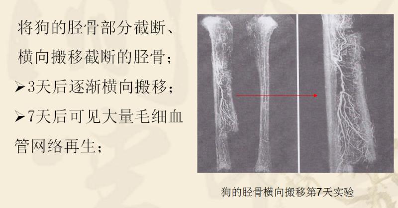 ilizarov外固定架胫骨横向搬移术治疗糖尿病足实例